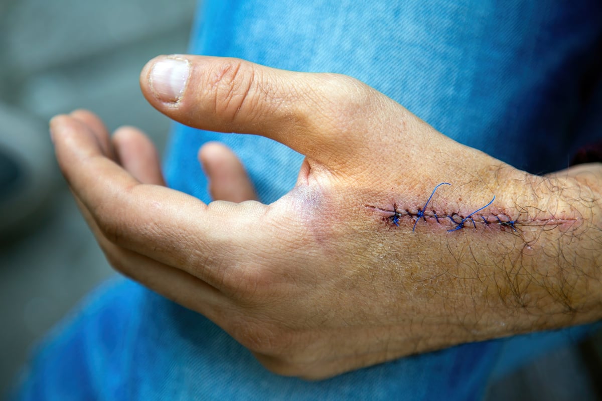 Close-up of a hand showing surgical stitches and a healing incision after surgery