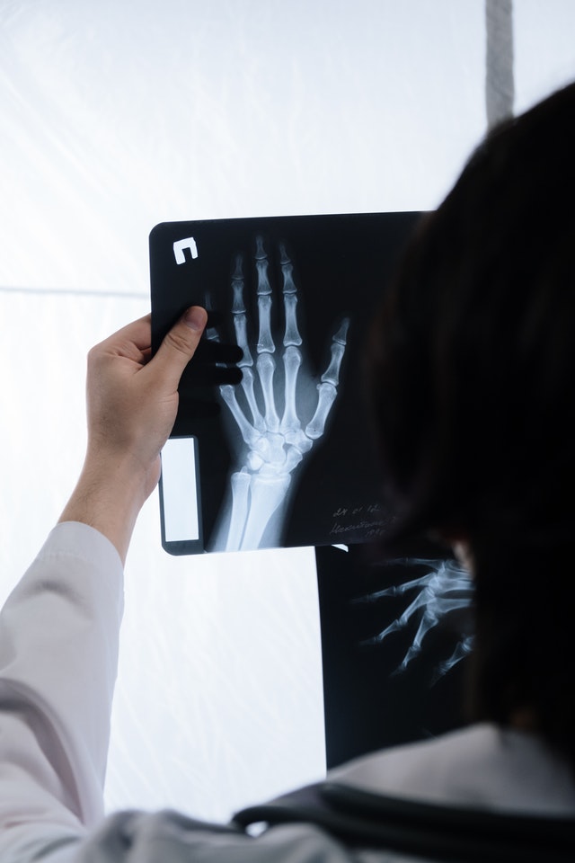 Hand x-ray needing Hand Surgery